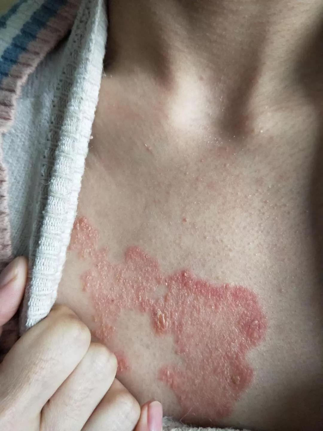 住海南就能使牛皮癣不治自愈吗,牛皮癣和体质有关系吗