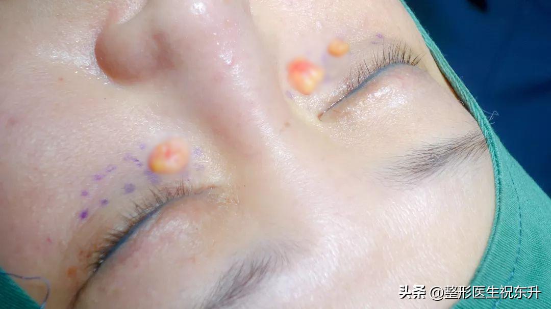 眼袋手术的真实感受,做过眼袋的人视频