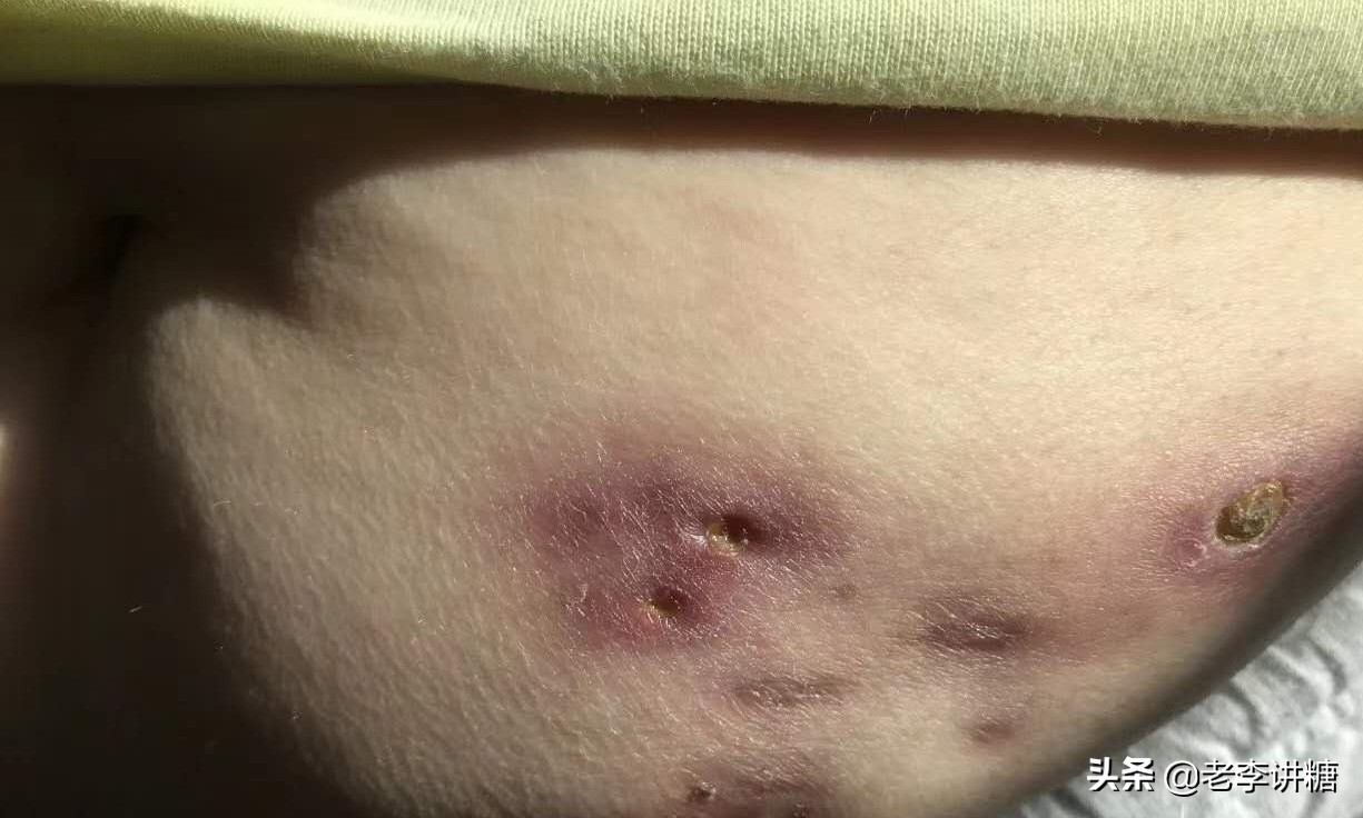 糖尿病无针胰岛素注射器能用多久,糖尿病胰岛素无针注射器价格表