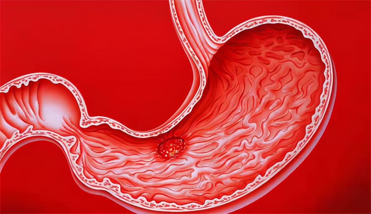 胃酸烧心吃奥美拉唑要吃多久,胃酸烧心吃奥美拉唑管用吗