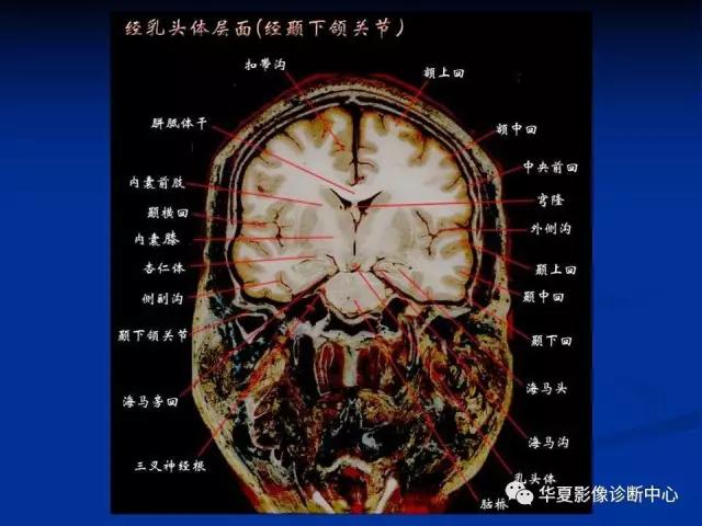电子版头颅ct与mri断层解剖,头颅mri血管解剖与分段详解