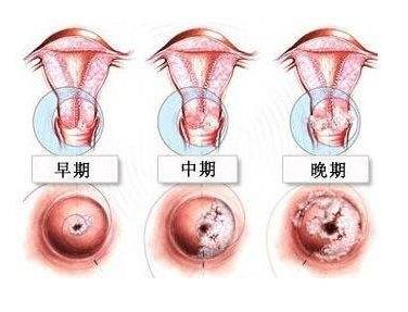 不同年龄段女性容易得宫颈癌吗,年龄较小患上宫颈癌可能性大吗