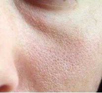 打败毛孔！下一个反孔精英就是你！