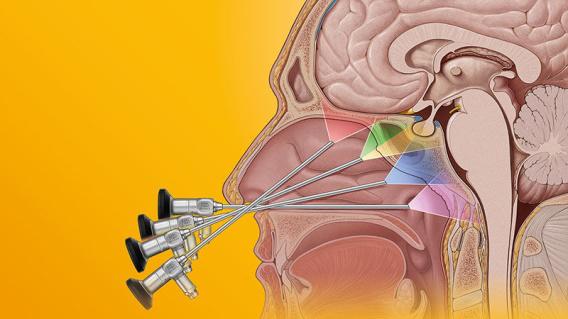 泌乳素型垂体瘤治好后可以怀孕吗,垂体瘤导致的泌乳素高能怀孕吗