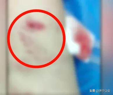 最新犬伤处置流程,关于犬伤处置