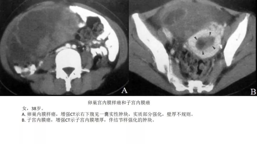 卵巢原发肿瘤的分析思路