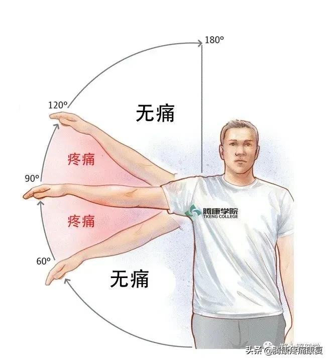 肩峰下撞击综合征的症状,肩峰下撞击综合征的机制是什么