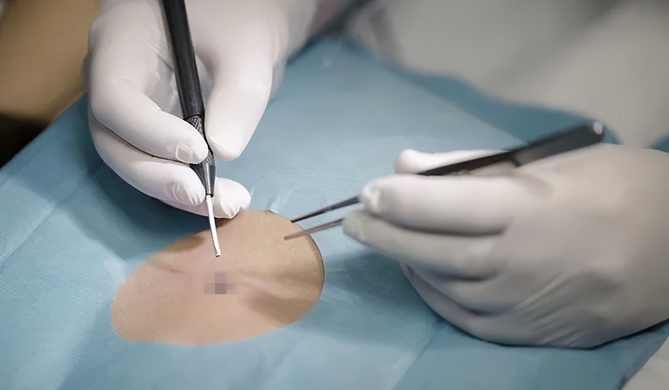 微创祛痣手术全过程,郝医生激光治疗仪疗效