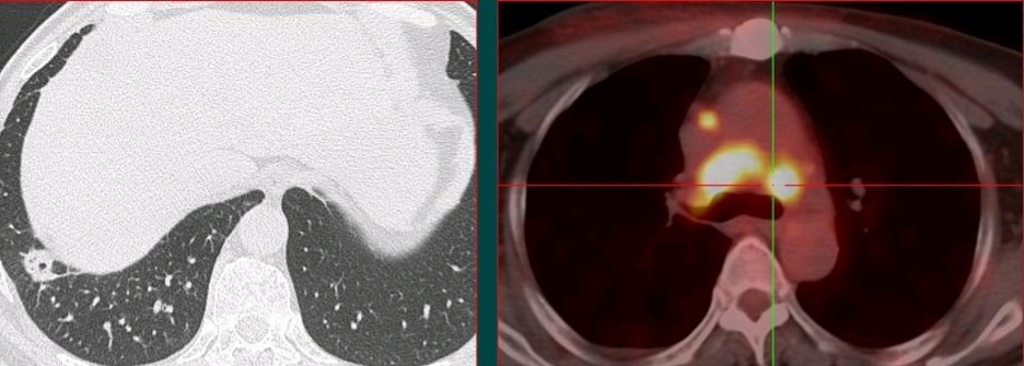 年年体检为啥查出癌症,每年正常体检能检查出肺癌吗