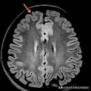 最先进有效的癫痫手术,癫痫手术是否能一次治愈