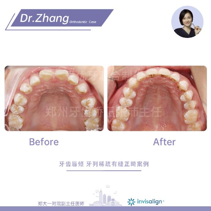 郑州矫正牙齿整形哪个医院好,郑州牙齿局部矫正