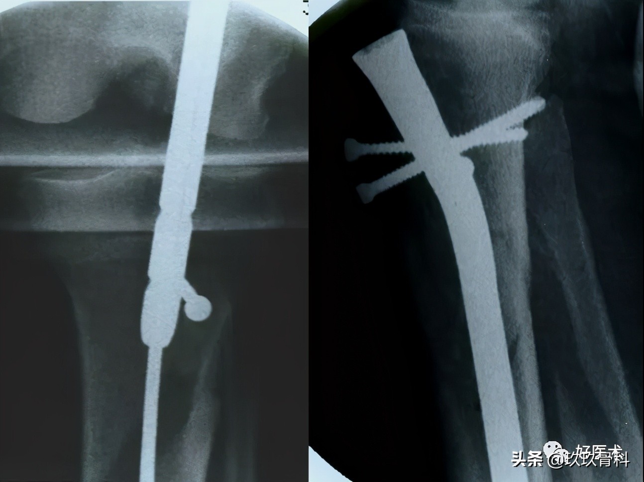 髓内钉技巧,髓内钉教学视频讲解