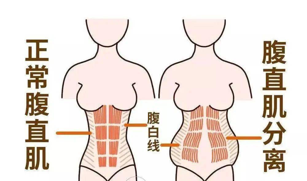 生宝宝选择剖腹产也需要做盆底肌修复，越早越好莫拖延