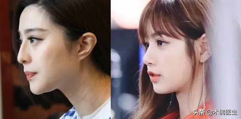 侧面鼻子很挺正面很塌,怎样判断鼻子的塌与挺