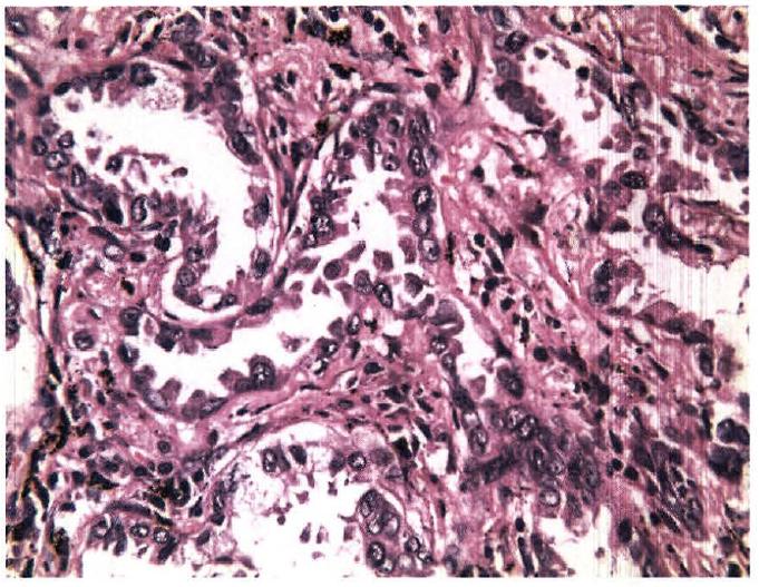 小细胞肺癌是指小结节吗,小细胞肺癌是肺细胞癌变吗