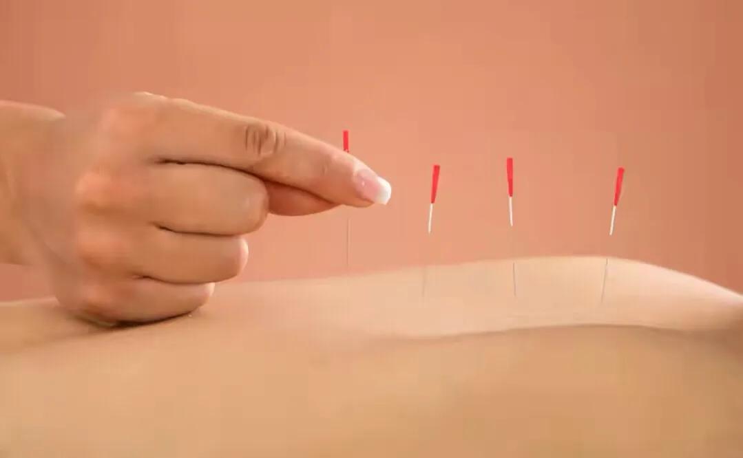 针灸治大病例子,针灸治疗常见疾病方法