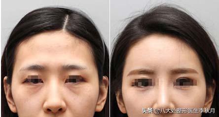 眼部细纹和眼袋泪沟怎么去除,赶走泪沟眼袋眼干没细纹