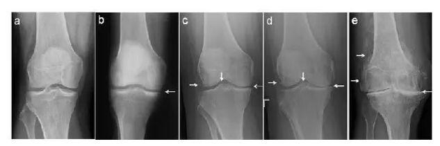 退行性骨关节炎，除了吃药还有这些