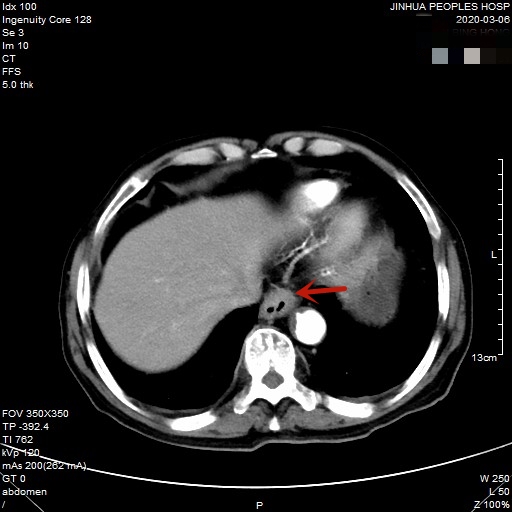 贲门癌80岁手术好还是保守治疗好,医生建议80岁老人做贲门癌手术