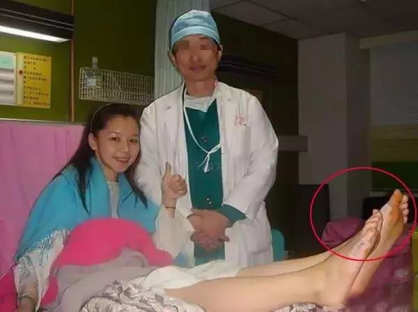 大脚趾拇指外翻矫正用多久,大脚拇指外翻导致第二脚趾弯曲