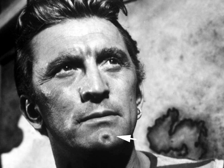 人造酒窝身体的缺陷,人造酒窝全过程