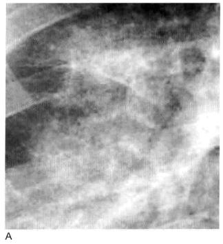 肺实变和肺炎的影像学区别,肺实变图