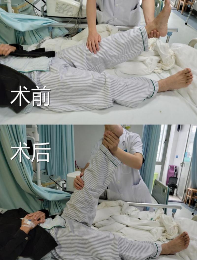 腰椎微创手术不做纤维环缝合,不开刀微创腰椎手术怎么做