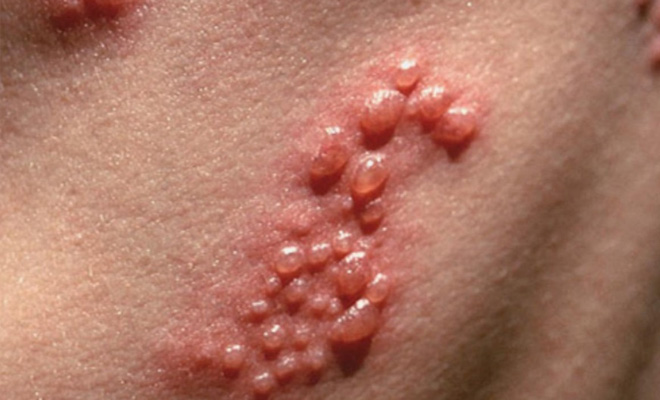 得了带状疱疹打疱疹疫苗还有用吗,得带状疱疹后能打带状疱疹疫苗吗