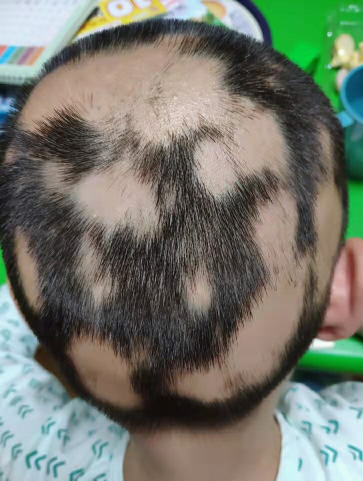 斑秃属于疑难杂症么,斑秃治疗中越来越严重怎么回事