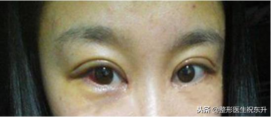 关于单眼皮整双眼皮的咨询话术,无痕双眼皮闭眼有肉条