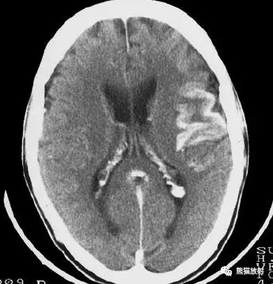 各部位脑梗死ct影像讲解,脑梗死ct影像最简单的是什么表现