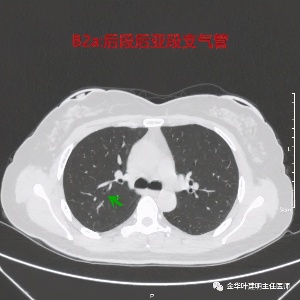 左肺上叶在ct影像上怎么看,平扫ct可以看出肺肿瘤的变化吗