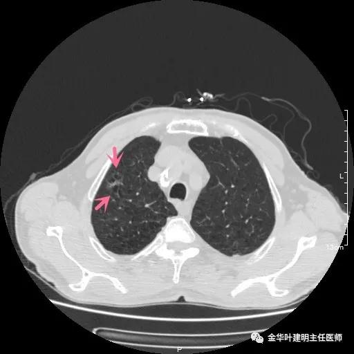 多发原发肺癌能根治吗,肺部原发性恶性肿瘤好治