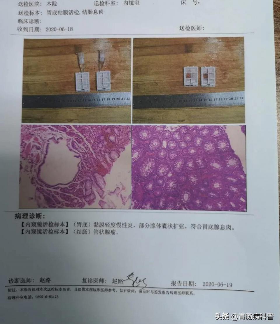 肠息肉切除后3年得肠癌,女性肠息肉切除多久可以恢复