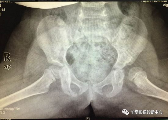 先天性髋关节脱位截骨术全过程,先天性髋关节脱位可以考驾驶证吗