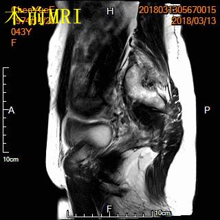子宫肌瘤介入栓塞术排出黄水,子宫肌瘤介入消融治疗