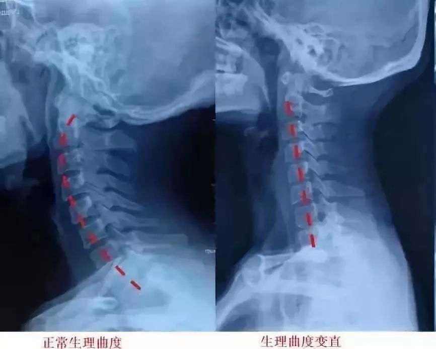 颈椎生理曲度变直如何能快速恢复,颈椎生理曲度变直能恢复吗