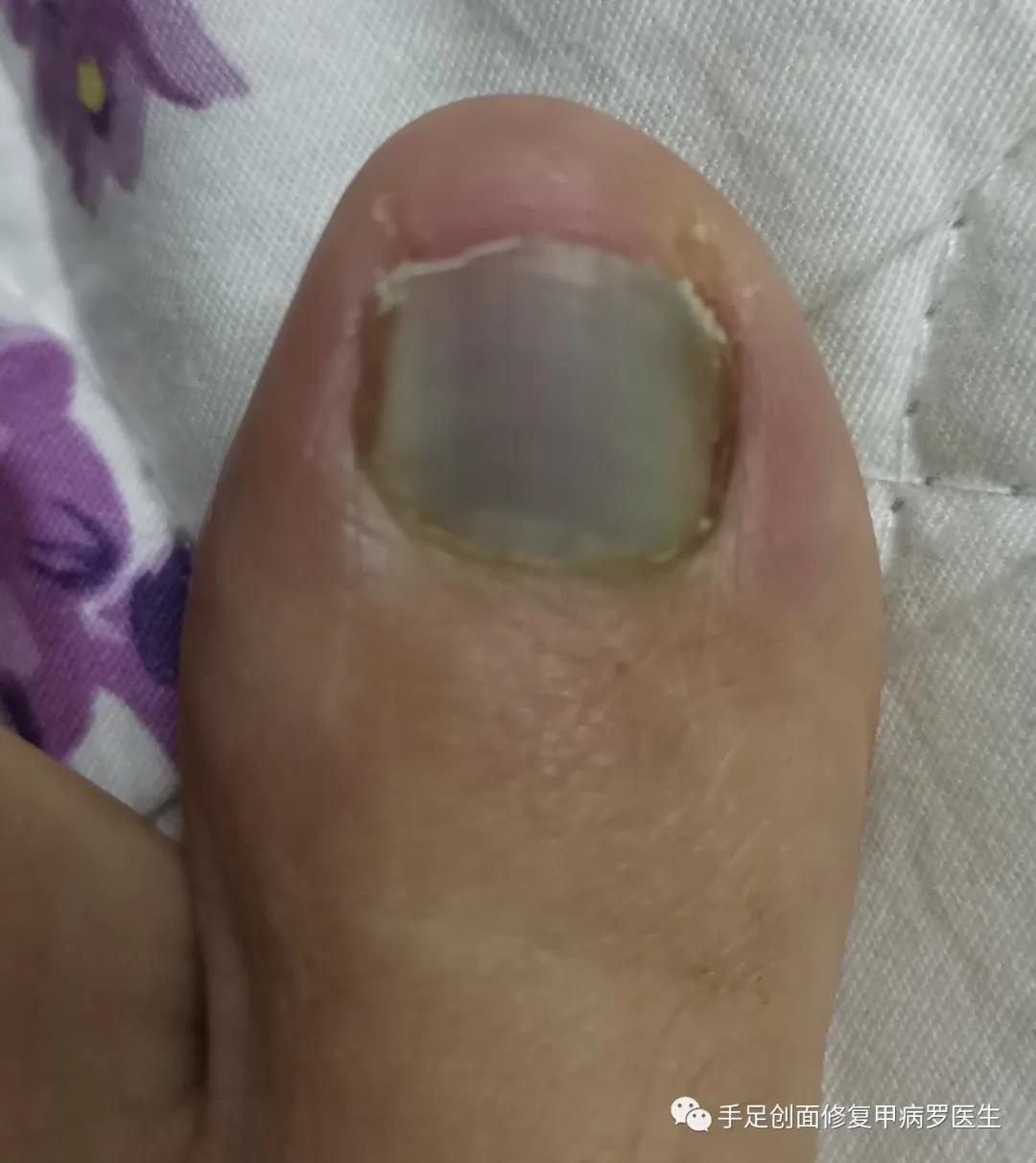 甲下积血放血后如何止血,甲下积血怎么办