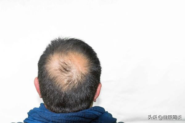 男人年轻就秃顶的原因是什么,为什么只有男性会秃顶