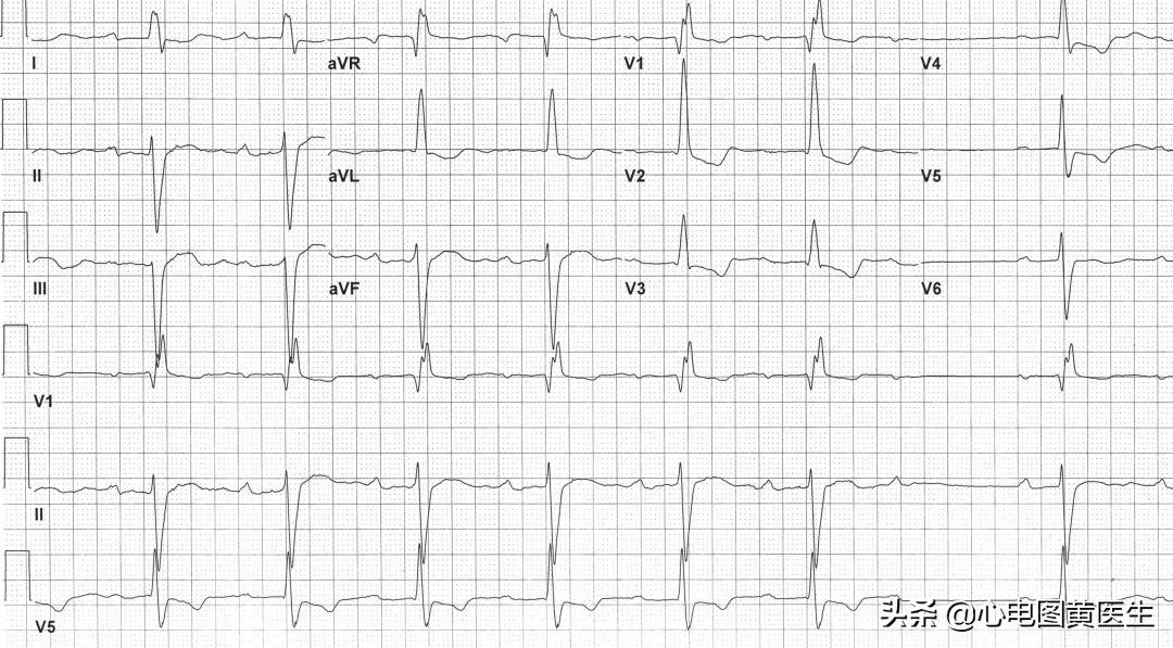 心电图左室高电压t波改变,心电图显示左室高电压和t波改变