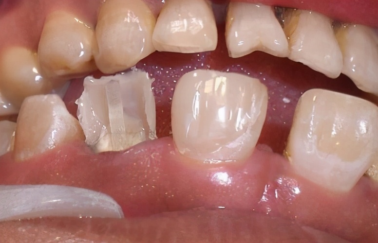 带牙冠里的牙齿烂掉了怎么办,戴的牙冠掉了发现牙根发黑