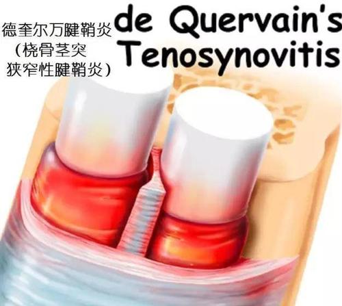 妈妈手如何恢复健康,妈妈手怎么处理