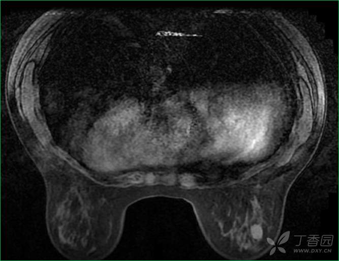 乳腺结节有消散的病例吗,一份完整的乳腺增生病例