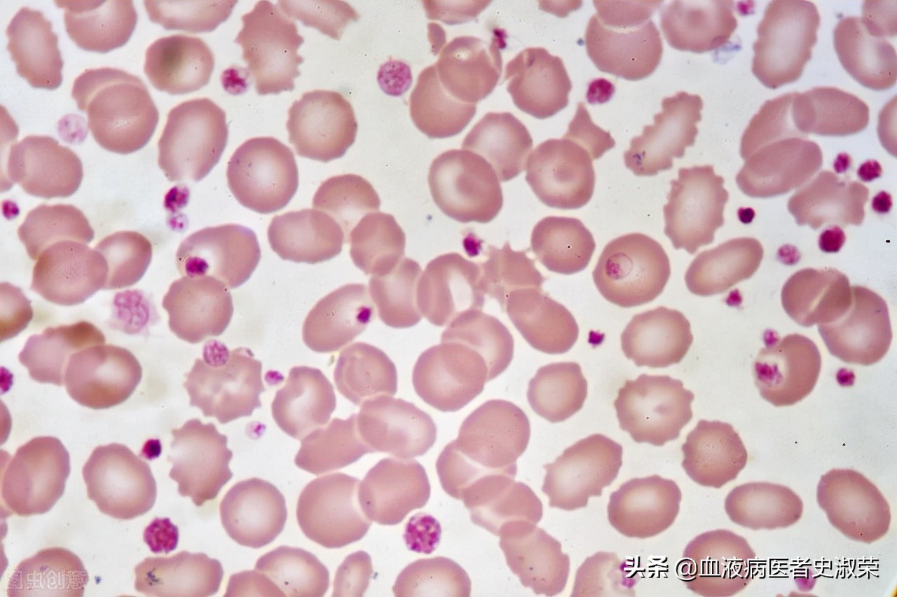 免疫性血小板减少停药会复发吗,血小板减少恢复5年了还会复发吗