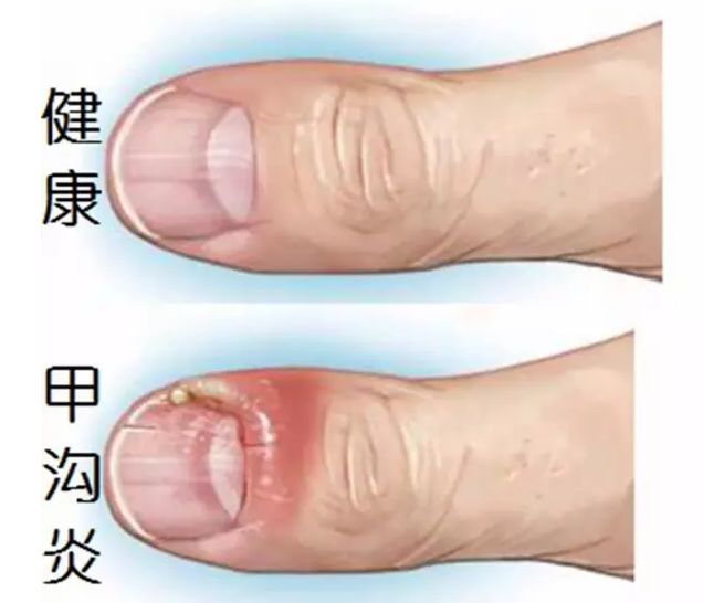 跑步后脚趾甲充血变黑怎么办,跑步为什么有黑指甲