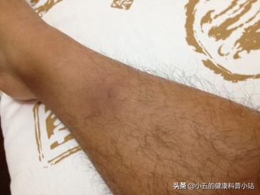 脚部丹毒初期,下肢丹毒要注意什么