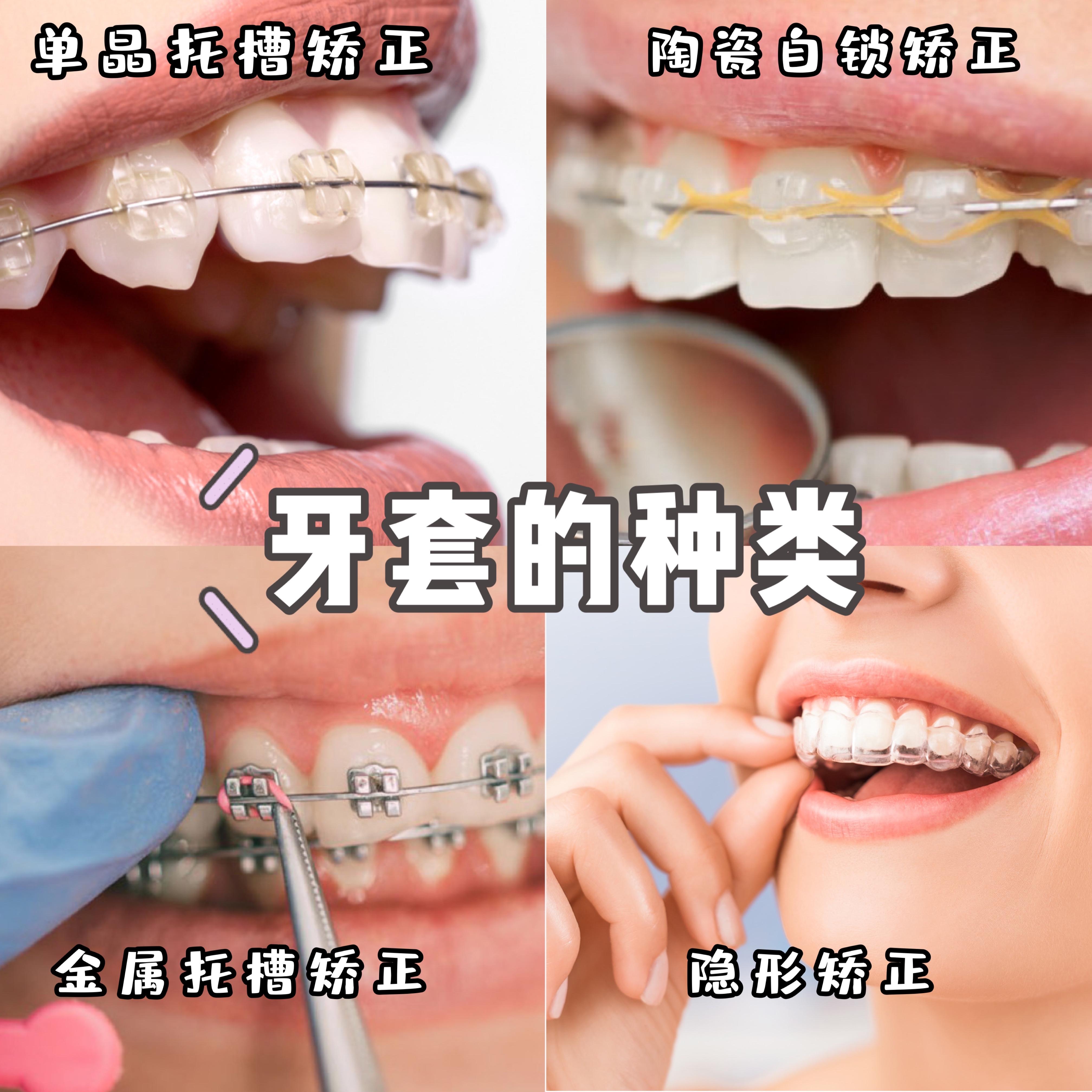 正畸矫正全过程分享,正畸医生的总结