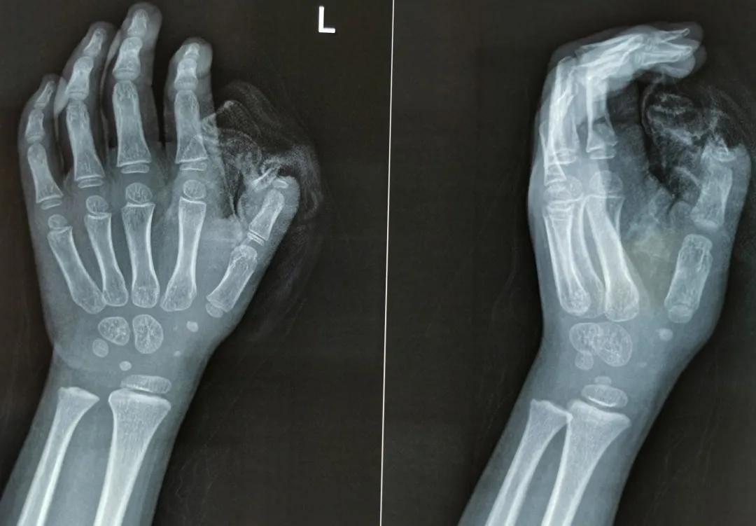 小女孩手被旋转门夹断,五岁小女孩手被门夹住