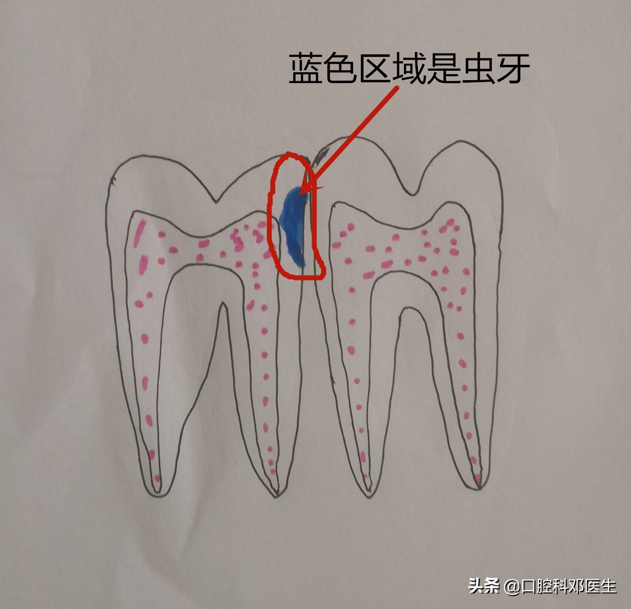 虫牙不及时补有什么后果,虫牙不治疗直接补能管多久