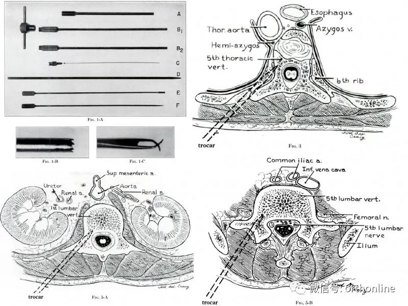 从“脊髓镜”谈到UBE/BESS:追溯脊柱内镜演化史(上)